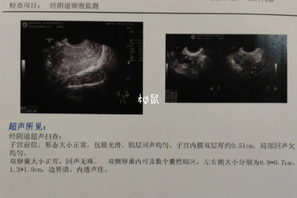 监测卵泡为不建议做阴超是预防感染