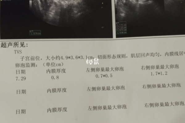 荷尔蒙水平异常会导致卵泡长不大